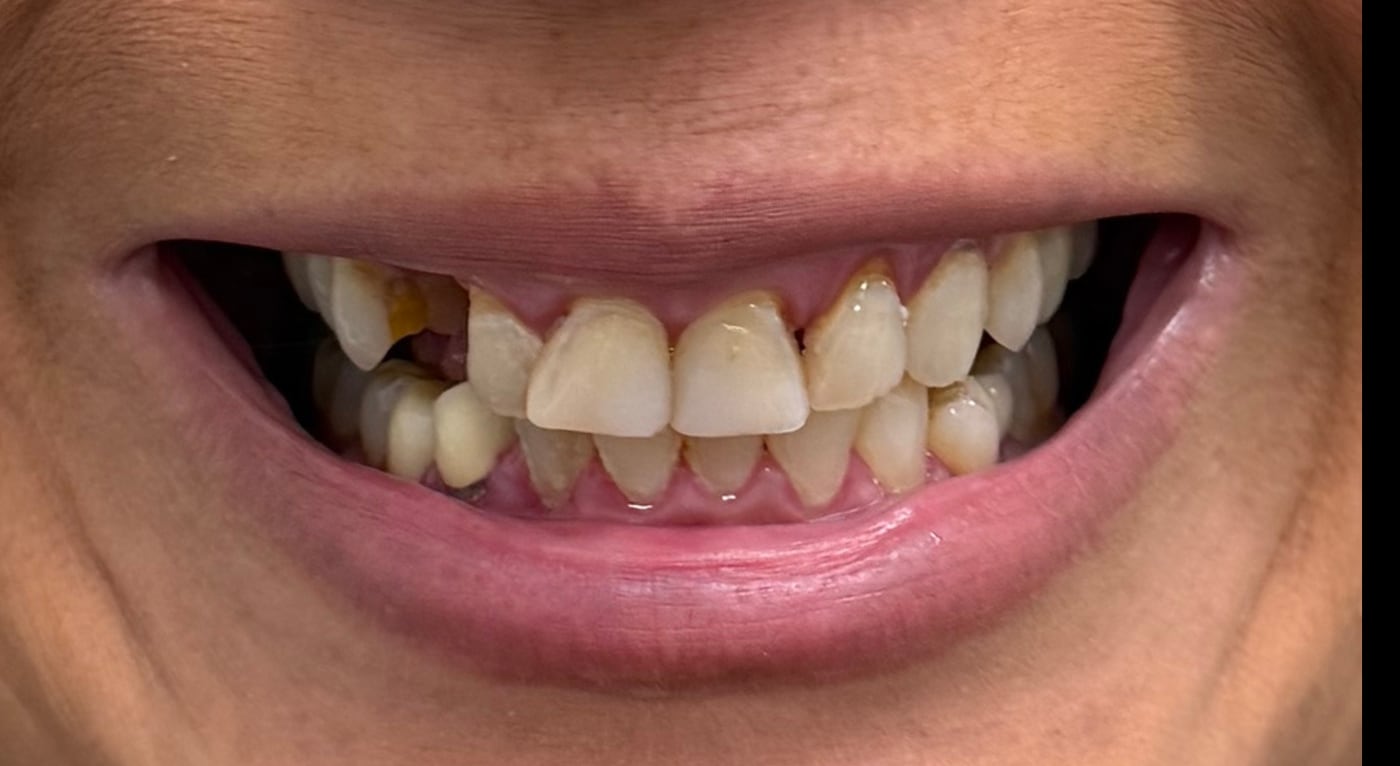 Before: rebuild a smile compromised by broken and failing teeth