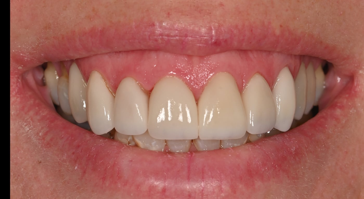 After: a uniform shade that still behaves like enamel instead of paint, by Dr. Peter Bonifatto, Las Vegas