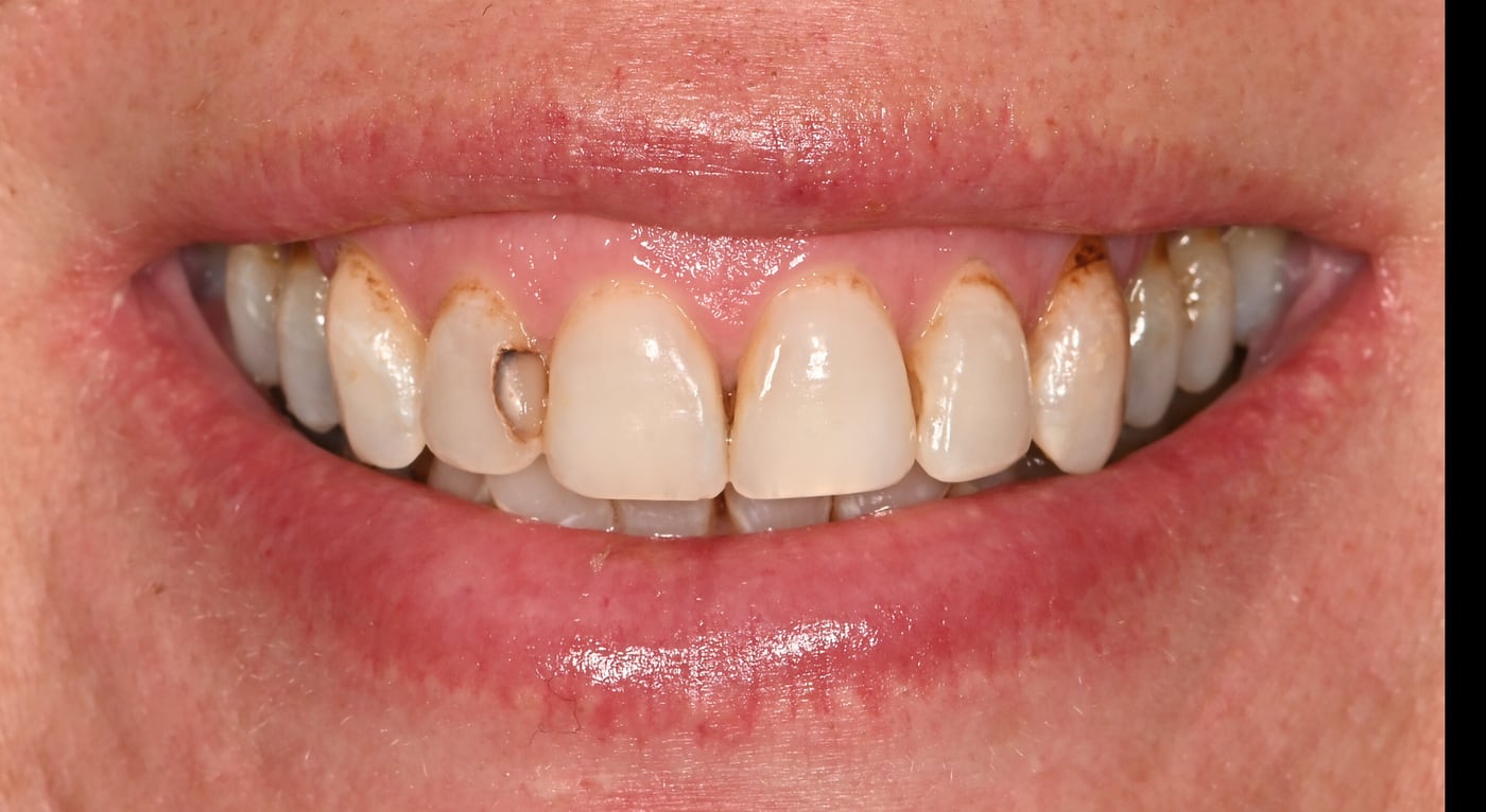 Before: colour that never matched from one front tooth to the next