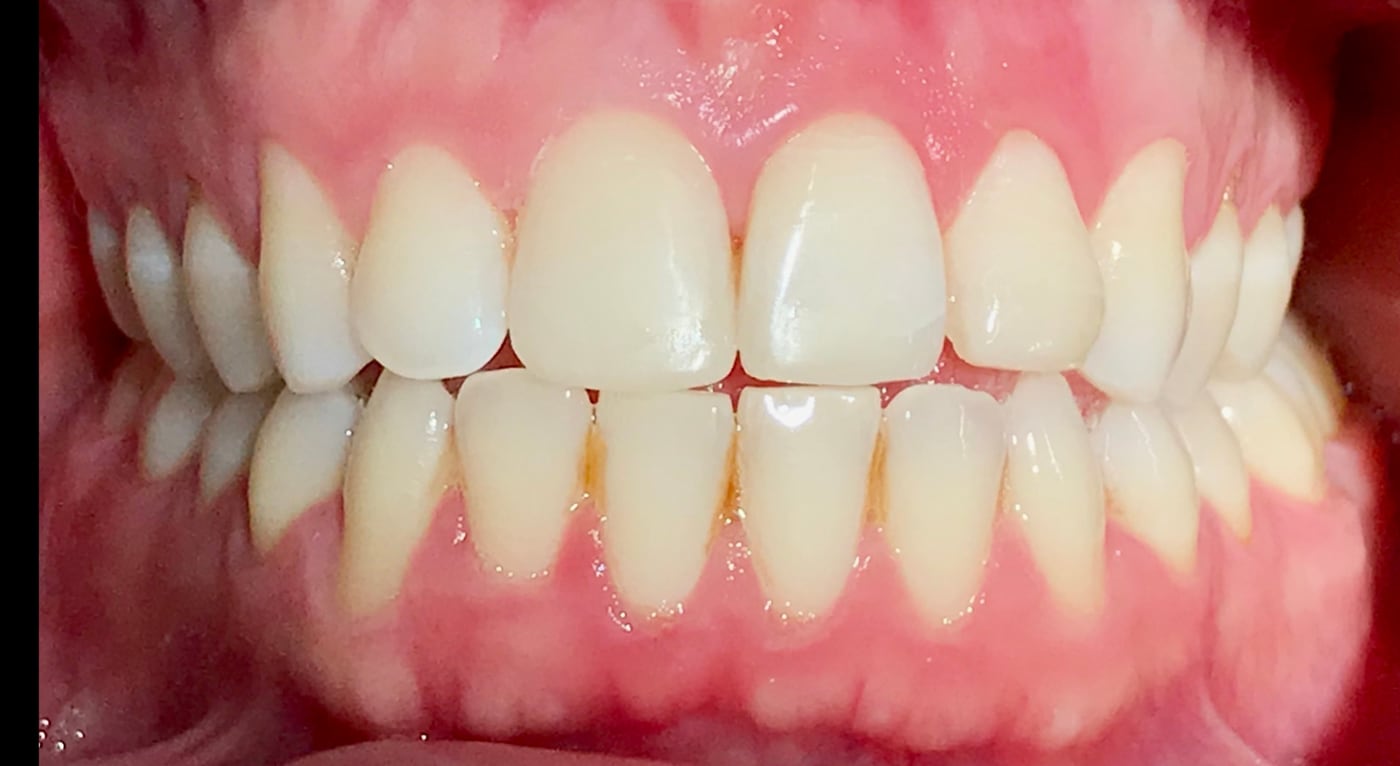After: the break is gone. bonding does not last forever, and porcelain stays available whenever he wants it, by Dr. Peter Bonifatto, Las Vegas
