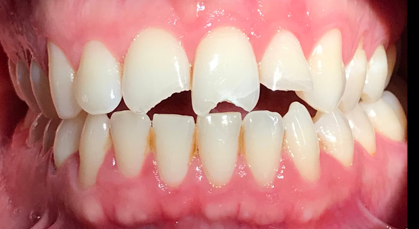 Before: repair upper front teeth broken in a bike accident