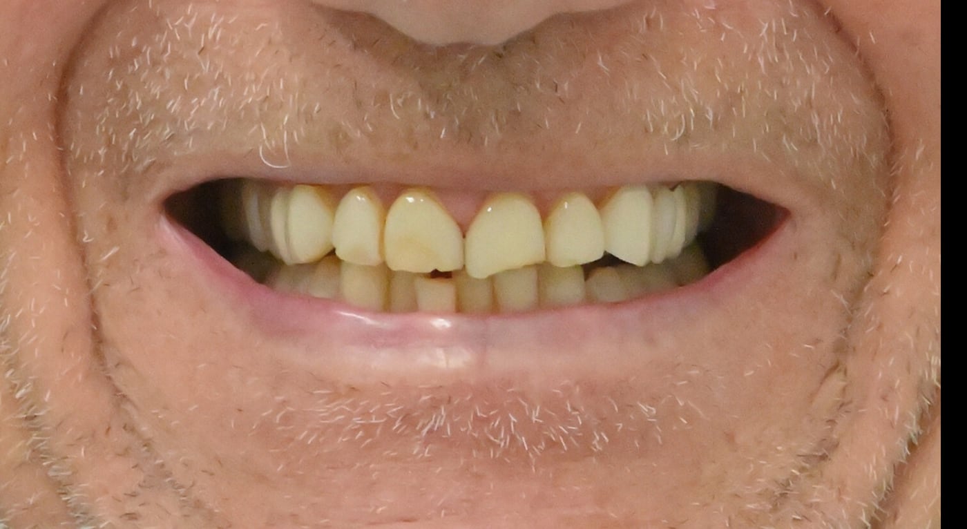 Before: front teeth worn short and discoloured after years of use