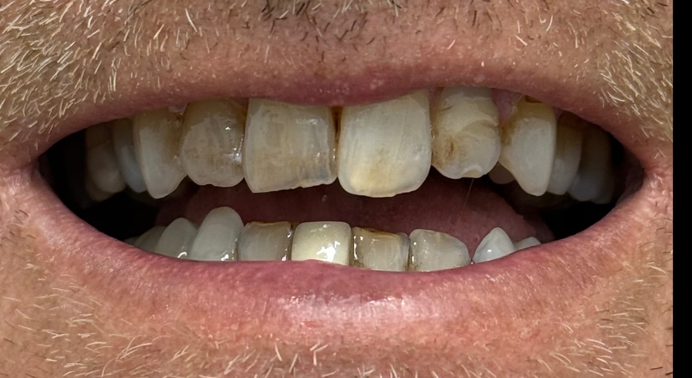 Before: correct deep staining and structural damage across the whole smile