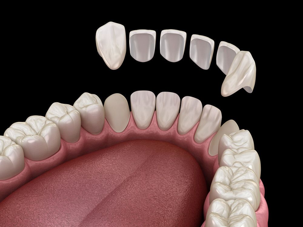 The same veneers seen from behind the arch, showing that each one is a thin hollow shell and that the tongue side of every tooth is untouched