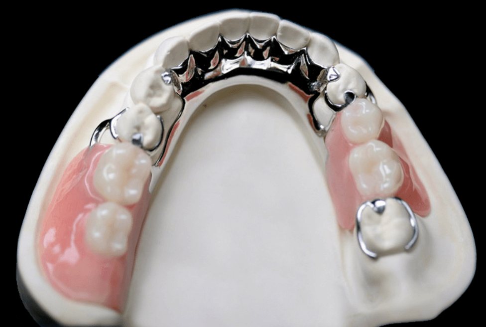 A metal partial denture on a model