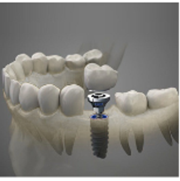 Implant